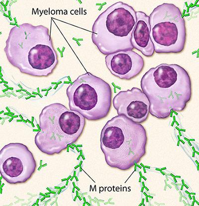 Medical illustration for the Multiple Myeloma information guide